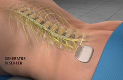 NorTex Spine & Joint Institute | Spinal Cord Stimulator Implant