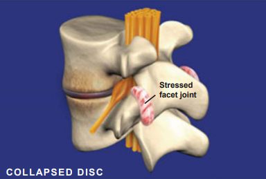 collapsed disc