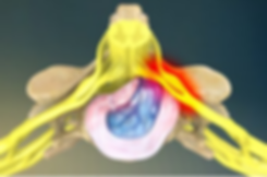 disc pain