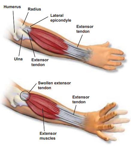 humerous, ulna, extensor tendon
