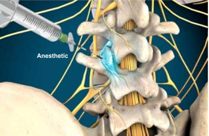 anesthetic
