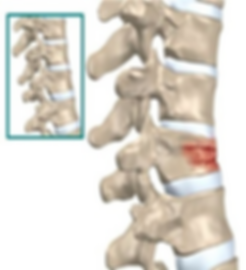 compression fracture