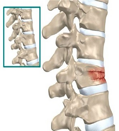compression fracture