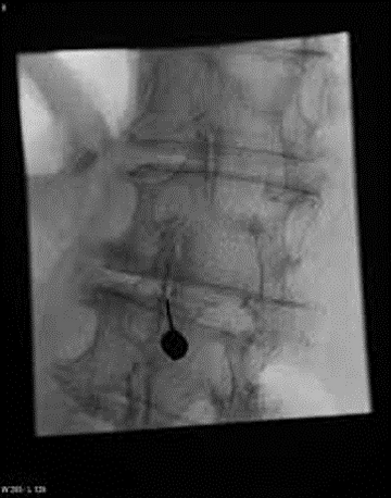 lumbar facet