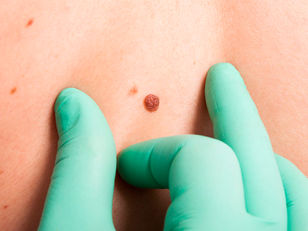 What Is Skin Cancer and Tips That Can Help Prevent It