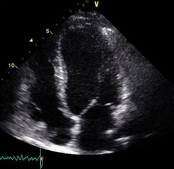 Exercise echo