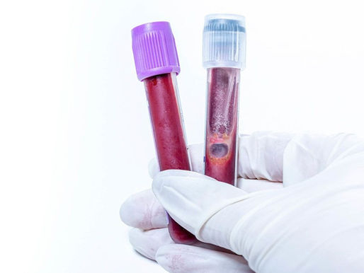 Unlocking the Silent Signals: How microRNA Could Predict Type 2 Diabetes Before Diagnosis