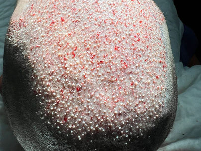 5000 Grafts Hair Transplant cost, COVERAGE & RESULTS IN 2026
