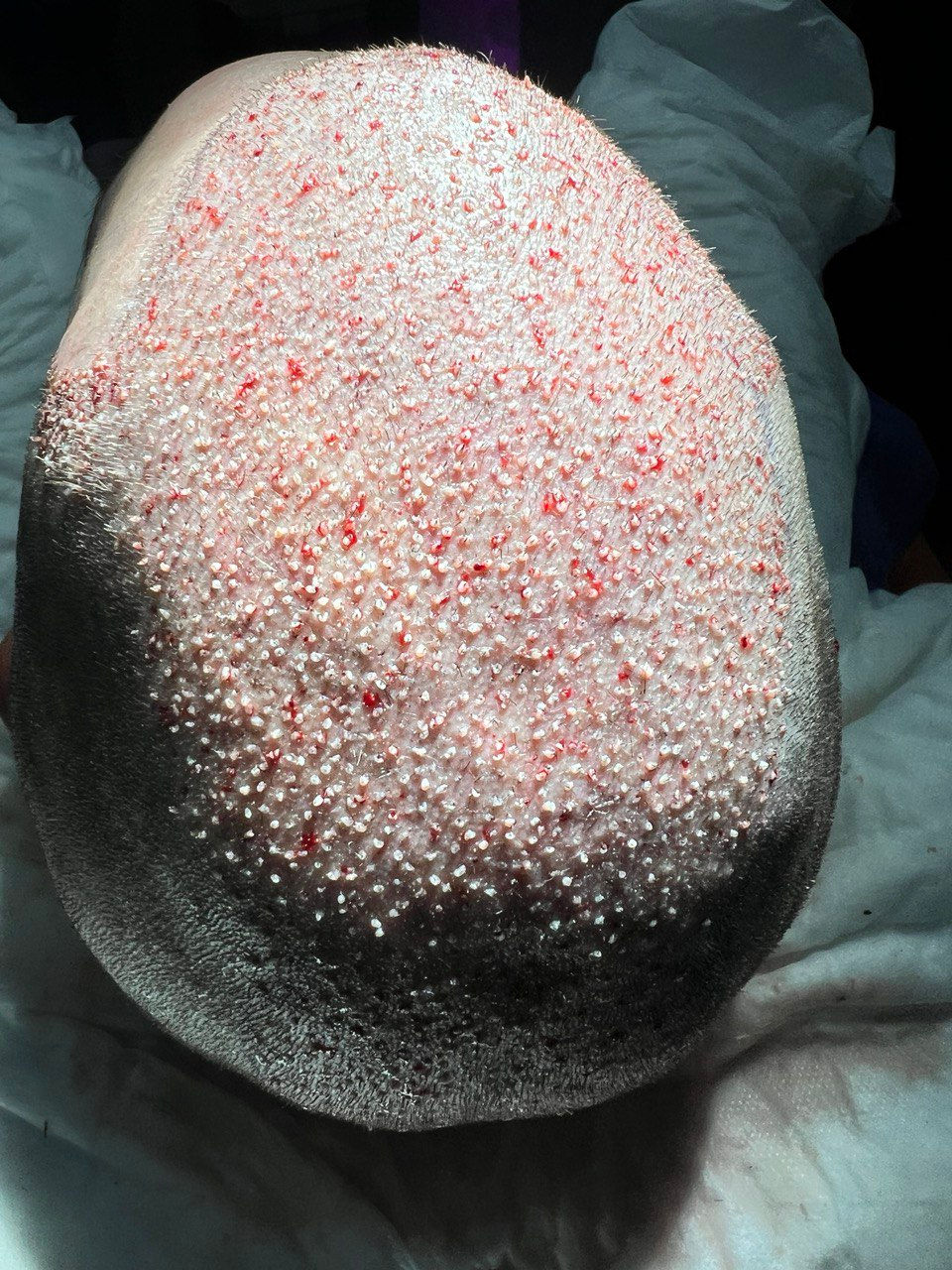 5000 Grafts Hair Transplant cost, COVERAGE & RESULTS IN 2026
