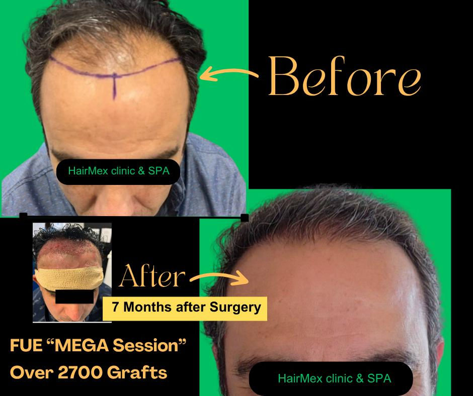 before and after FUE/DHI hair transplant 2700 grafts HairMex Clinic Tijuana Mexico Branch
