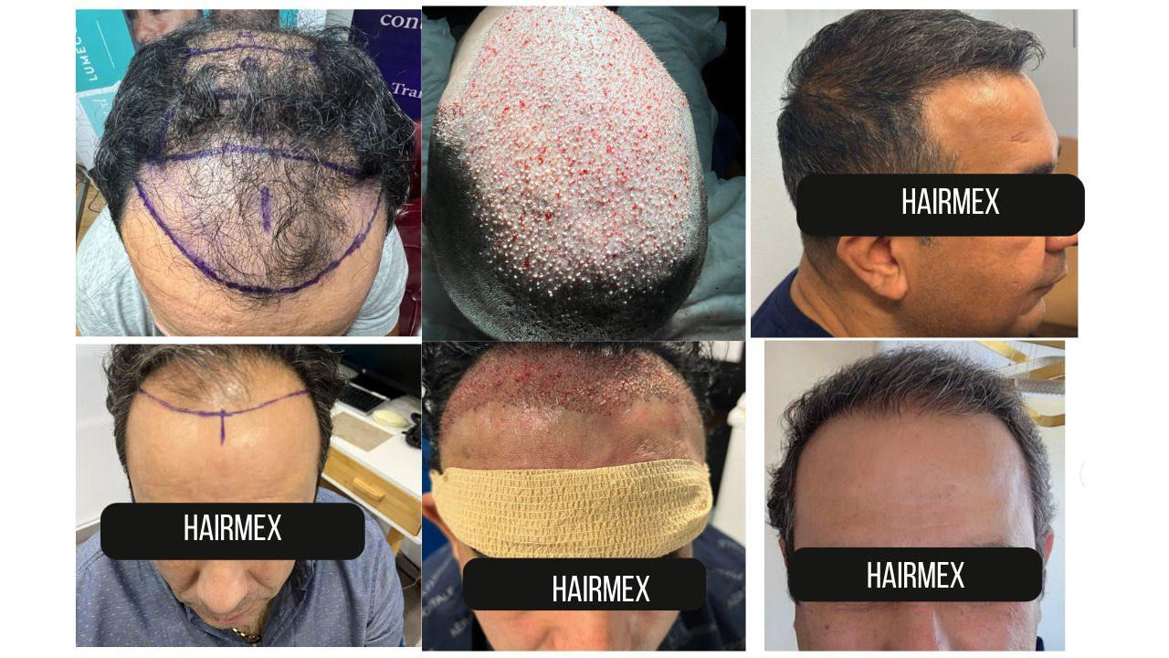 before and after pictures of HairMex clinics using FUE/DHI method at Tijuana branch