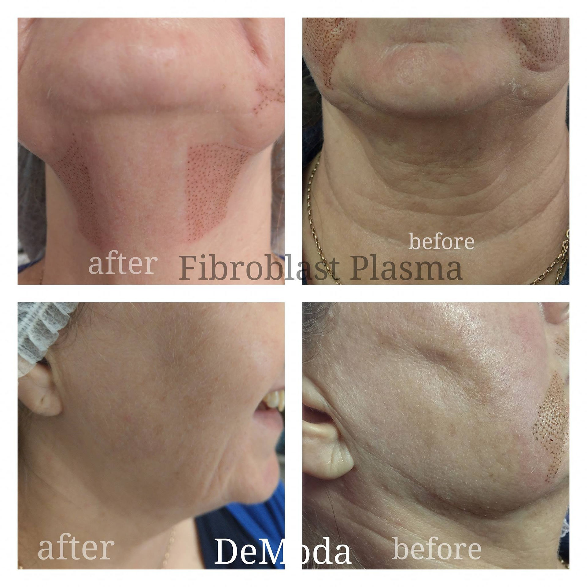 Fibroblast Plasma Skin Tightening