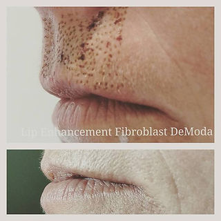 Fibroblast Plasma Smokers Lines