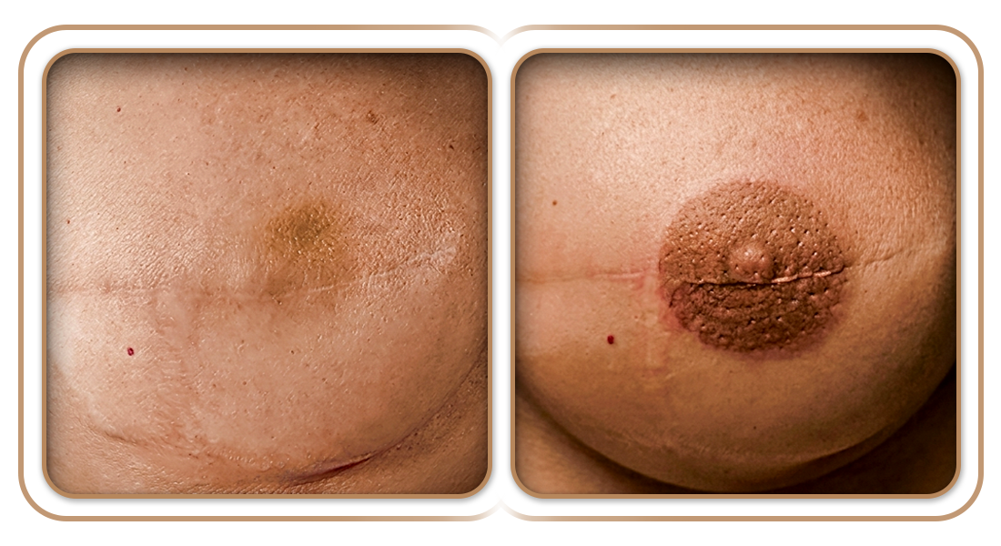 B&A-Prcd-Areolas.png