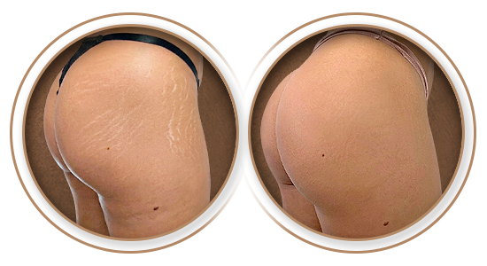 Antes e Depois | Tratamento e Camuflagem de Estrias