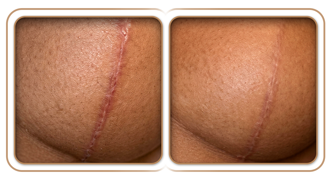 B&A-Prcd-Mastopexia.png