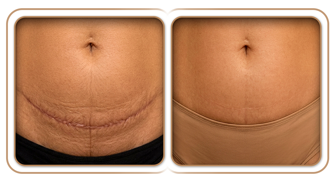 B&A-Prcd-Abdominoplastia.png