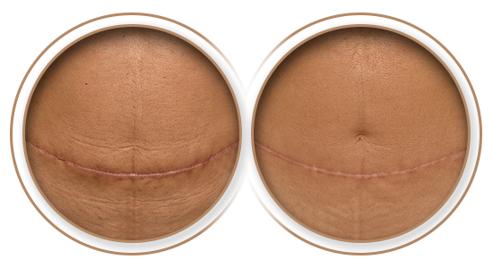 Antes e Depois | Tratamento de Cicatriz em Abdominoplastia