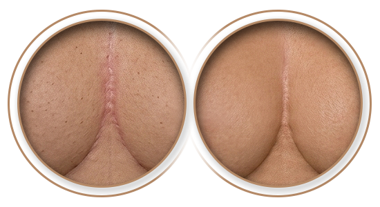 Antes e Depois | Tratamento de Cicatriz em Mastopexia