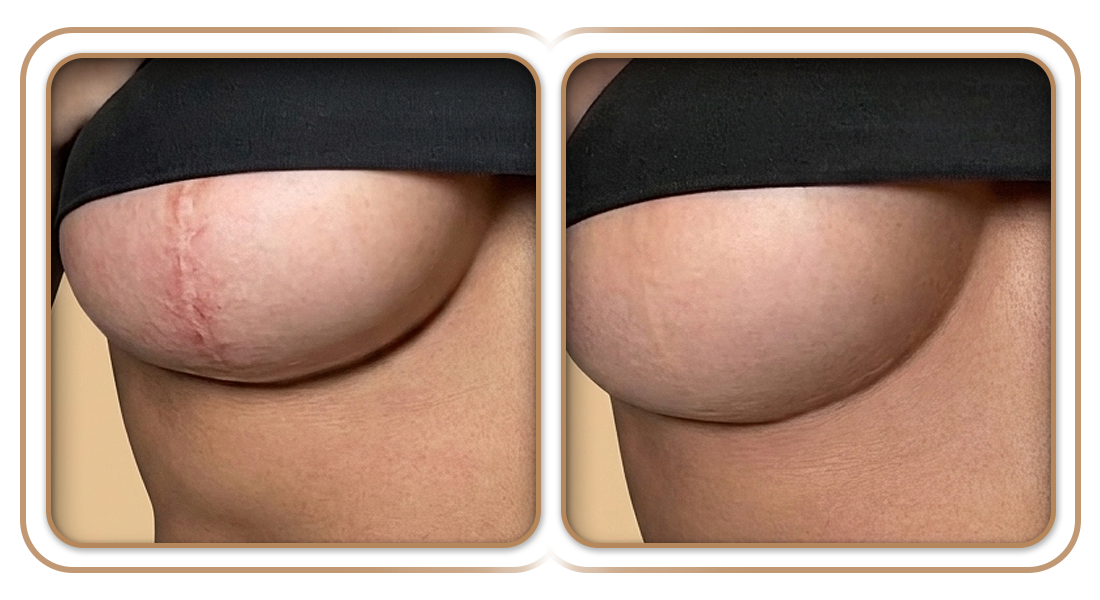 Antes e Depois | Tratamento de Cicatriz em Mastopexia