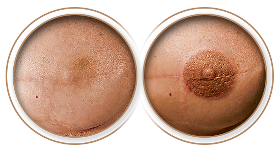 Antes e Depois | Reconstrução de Areolas