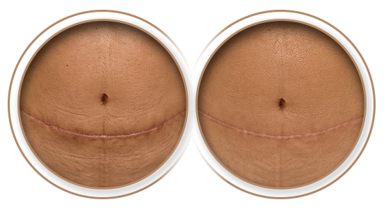 Cicatriz em Abdominoplastia