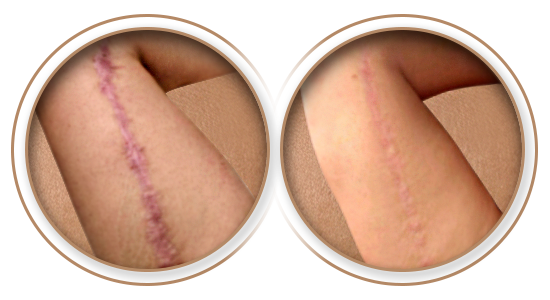 Antes e Depois | Tratamento de Cicatriz em Braquioplastia