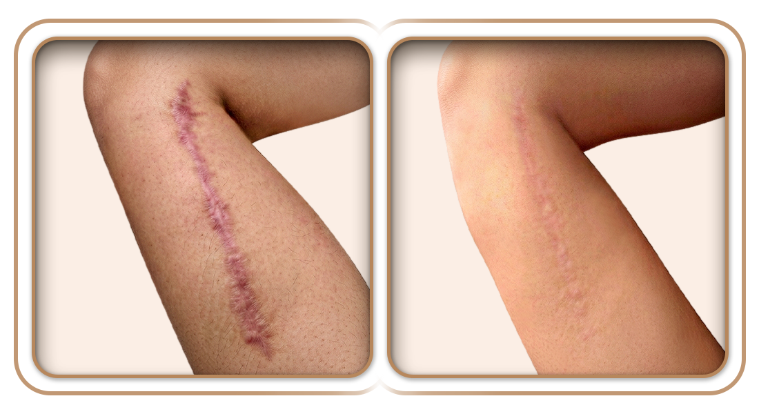 B&A-Prcd-Braquioplastia.png