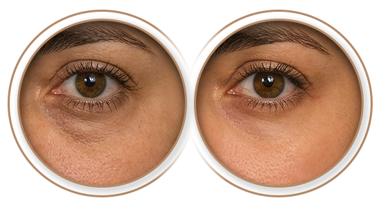 Antes e Depois | Neutralização de Olheiras