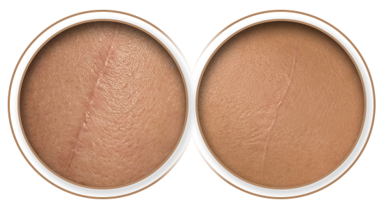 Antes e Depois | Tratamento de Cicatrizes