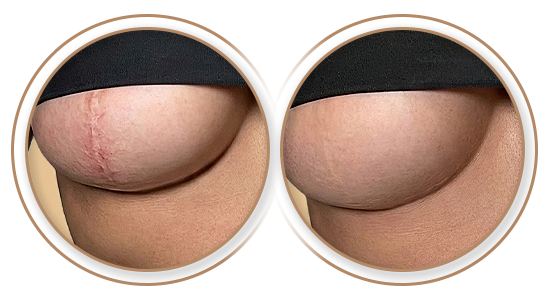 Antes e Depois | Tratamento de Cicatriz em Mastopexia