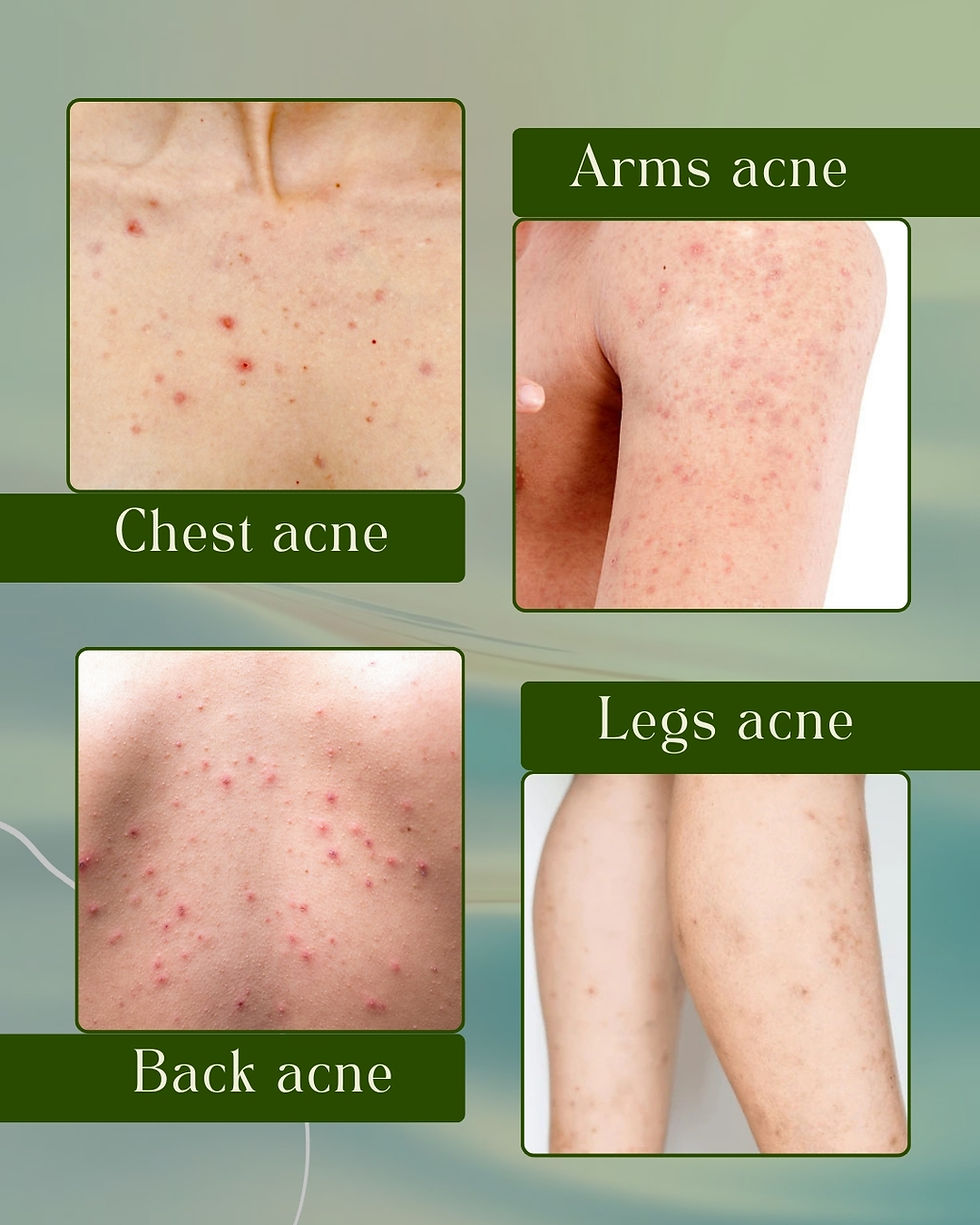 Image collage showing different forms of body acne including chest acne, arm acne, back acne and acne on the legs. The photos highlight inflamed bumps, clogged pores, folliculitis-like acne and widespread breakouts commonly seen on the torso and limbs. Designed to educate clients on identifying body acne and understanding why professional treatment may be required. Relevant keywords: body acne treatment Southall, back acne removal, chest acne solutions, arms acne treatment, legs acne marks, SQT Bio Microneedling for body acne, non-invasive acne treatment UK, acne clinic near me, The Aeon Aesthetics skin clinic.