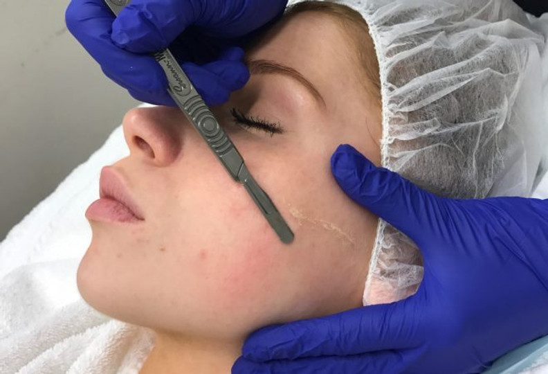 Dermaplaning-660x450.jpeg