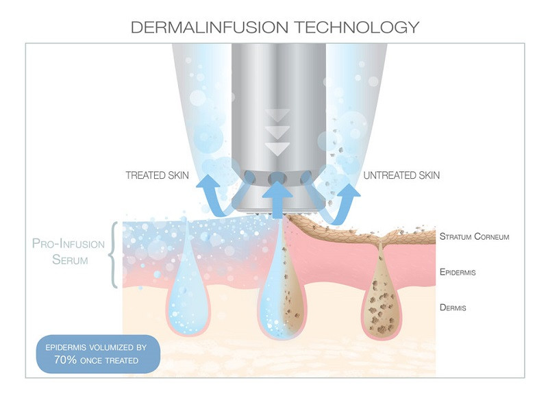 Demal Infusion Treatment