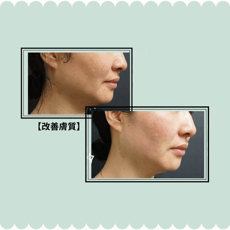 傳統HIFU (6).gif