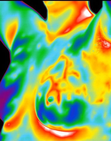 Breast thermography imaging Fort Myers