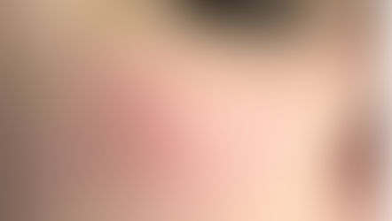 The Source Membership - Rosacea & Redness