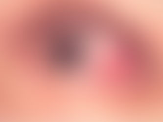 Derrame Ocular - Hipertensão Arterial é uma causa comum.