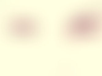 Nistagmo - Pode ser sintoma de doenças graves