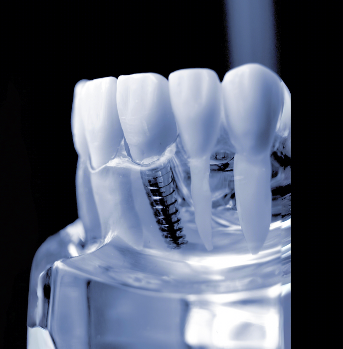 Creativ Dent Dental Implant