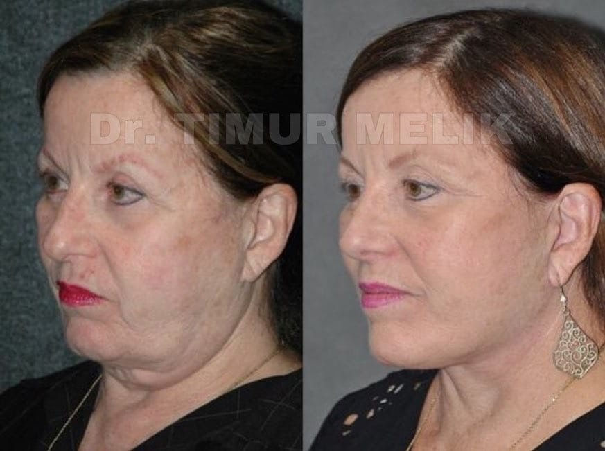 Подтяжка лица 12