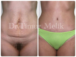 Абдоминопластика живота Ярославл4535