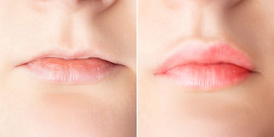 Lip augmentation before and after close up. Woman lips surgery, filler injection, mesother