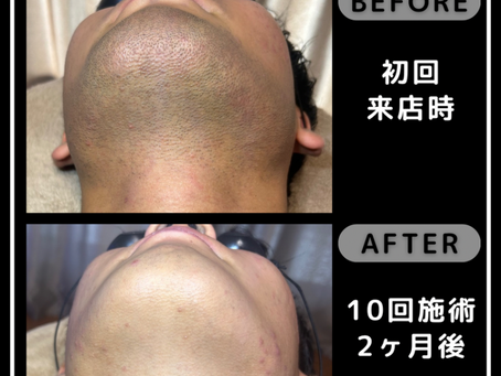【ヒゲ脱毛の効果を最大化するための通い方】熊本 メンズ脱毛