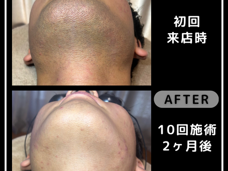 ヒゲ脱毛のメリット 熊本 メンズ脱毛