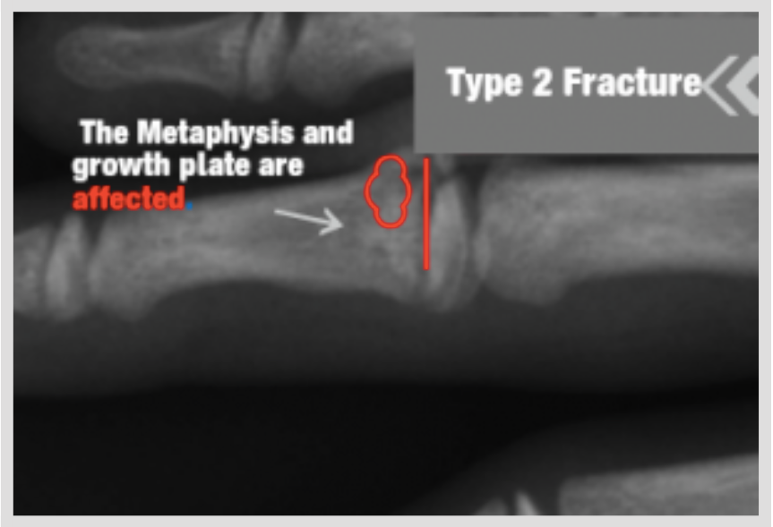 Growth Plate Fractures Part 2