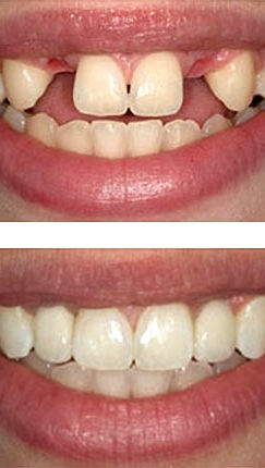 Ejemplo-Implantes-dentales_edited.jpg