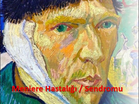 Meniere Hastalığı