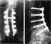 osteosintesisAcibiomedica.jpg