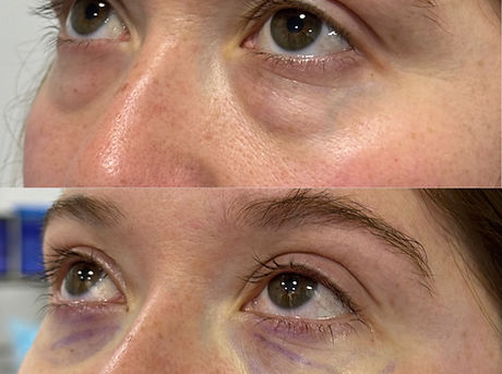 Párpados inferiores